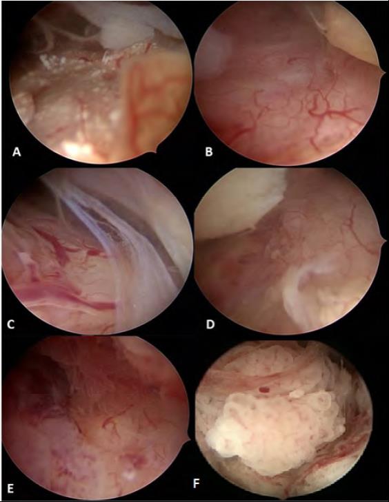 A. Calcificaciones hiperintensas. B. Patrón vascular anormal. C. Áreas de necrosis, patrón algodonoso. D. Superficie endometrial irregular y áreas de patrón algodonoso. E. Superficie endometrial irregular, áreas de proyecciones papilares, áreas de necrosis y patrón vascular mixto. F. Proyecciones papilares endometriales.