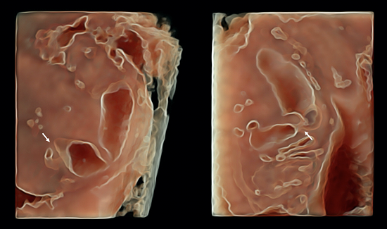 Atresia de la segunda porción del yeyuno en un feto de 22 semanas identificada mediante ecografía 3D con reconstrucción en superficie (HDlive). Se observa dilatación de la porción proximal de yeyuno previa a segmento intestinal atrésico (flecha).