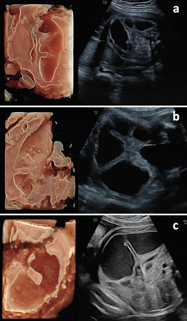Correlación clínica de los hallazgos con ecografía 2D y 3D con reconstrucción en superficie (HDlive). Se observa dilatación excéntrica de asa única de intestino delgado que sugiere la presencia de atresia de yeyuno, con diámetro máximo de 18,0 mm en semana 29 (a), 22,1 mm en semana 32 (b), y 25,0 mm en semana 35 (c). Durante el seguimiento realizado a semana 35 (c), se evidencia dilatación pronunciada de la porción proximal de yeyuno, compatible con vólvulo proximal. No se observan signos de sufrimiento de asa o perforación (v.g. aumento de grosor parietal o ascitis).