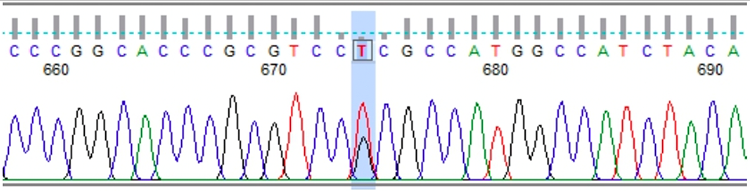 Electroferograma de la paciente del caso.