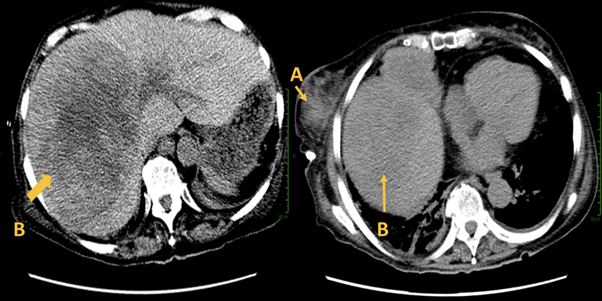 Tomograf&iacute;a por emisi&oacute;n de positrones que muestra tumor secundario: A) LNH primario de la mama y B) Lesi&oacute;n hep&aacute;tica 