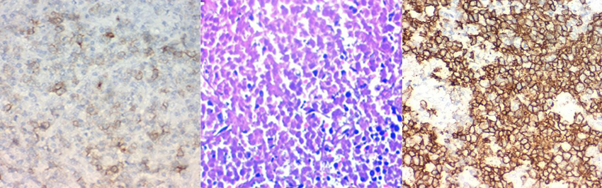 Inmunohistoqu&iacute;mica que muestra CD5, CD10 y CD20 positivos. 