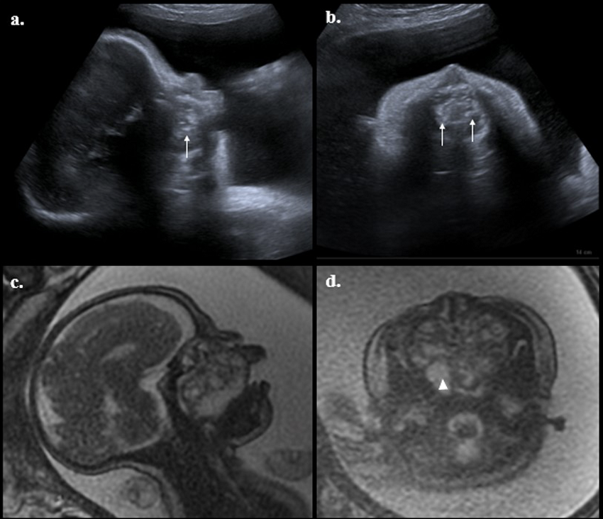 Ecograf&iacute;a obst&eacute;trica y resonancia fetal.