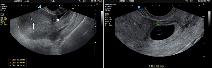 Embarazo ectópico en cicatriz de cesárea. En la imagen superior, ultrasonografía en sagital, mostrando la cavidad endometrial vacía (flecha larga) y el saco gestacional implantado en la cicatriz (flecha corta). En la imagen inferior, miometrio residual, medido desde el saco gestacional hasta la serosa de la pared uterina. 