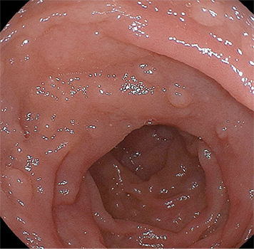 VEDA: mucosa de segunda porción duodenal con
aspecto granular y pliegues conservados.