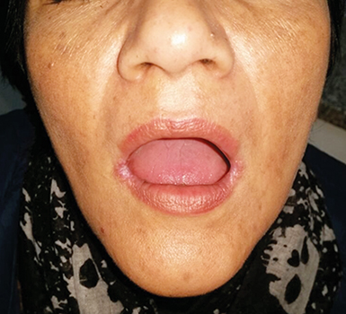 Queilitis angular.

 