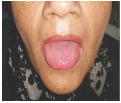 Lengua depapilada.