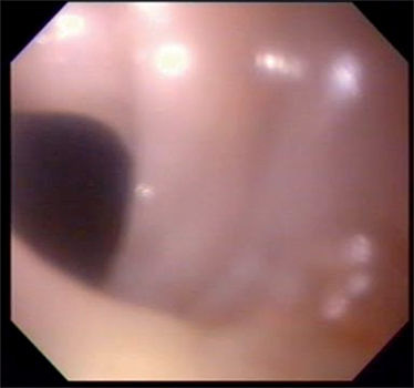 Membrana esofágica superior, blanco grisácea,
que ocupa el 25% de la circunferencia, visualizada durante la realización de la
VEDA.