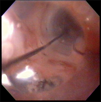 Dilatación endoscópica con balón neumático de
expansión radial controlada (Boston Scientific® 10-12
mm) sin complicaciones inmediatas ni tardías posteriores al procedimiento.