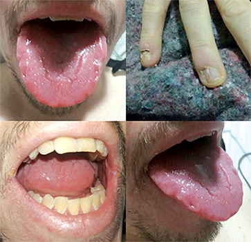 Al examen físico la presencia de glositis atrófica, coiloniquia y queilitis angular.