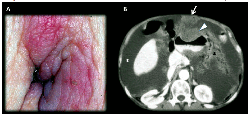 Man 56 years old, advanced gastric neoplasm. A) Picture of the umbilical
lesion; B) Contrast enhanced MDCT axial slice, in portal-venous phase: Large
neoplastic lesion that bulge the anterior wall of the gastric wall (arrow head)
with transmural involvement with non-defined borders,
that invades the omentum [black asterisk (*)];
ascites [white asterisk (*)]; metastatic umbilical nodule (SMJN)(arrow).