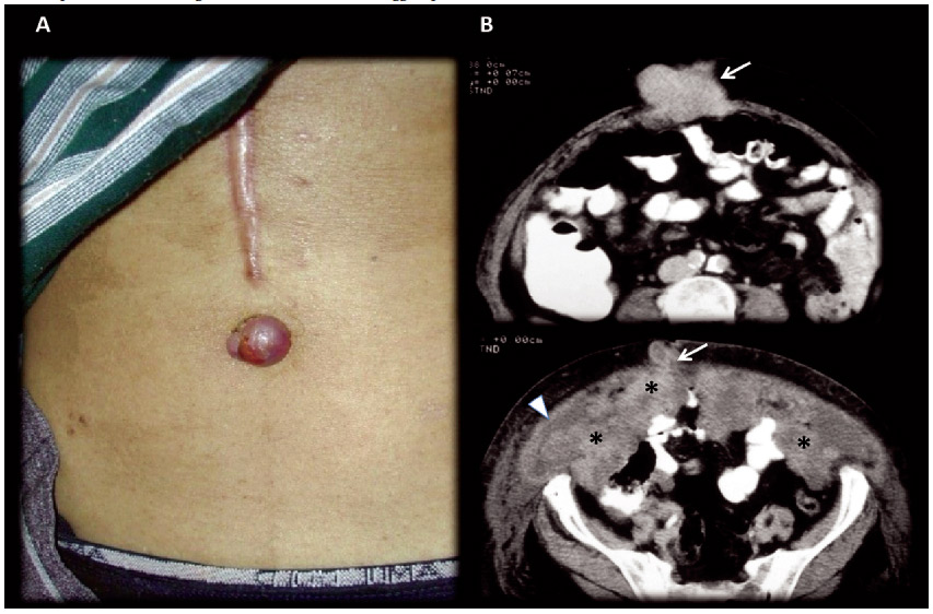 Man 45 years old,
recurrence of surgically treated gastric neoplasm.