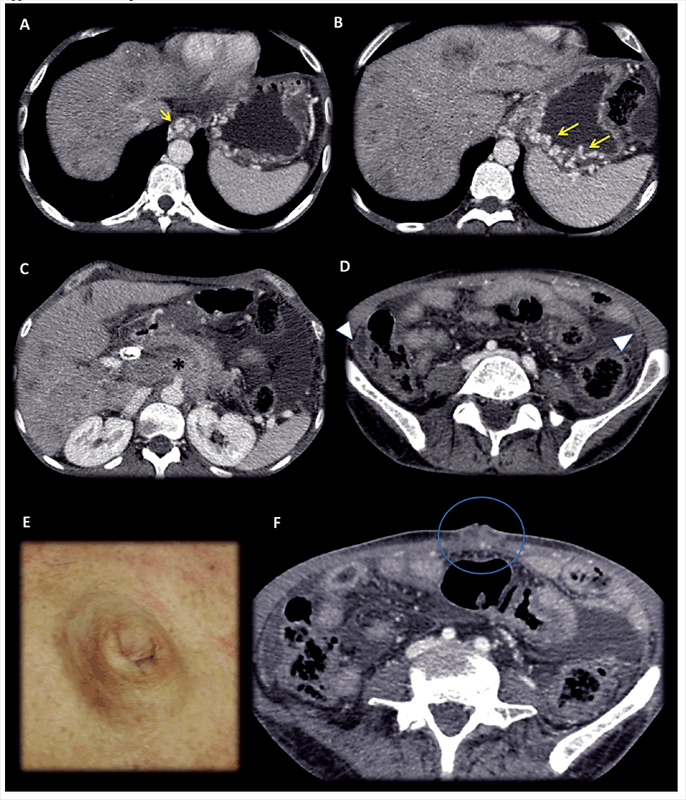 Man 48 years
old, advanced pancreatic cancer in palliative care.