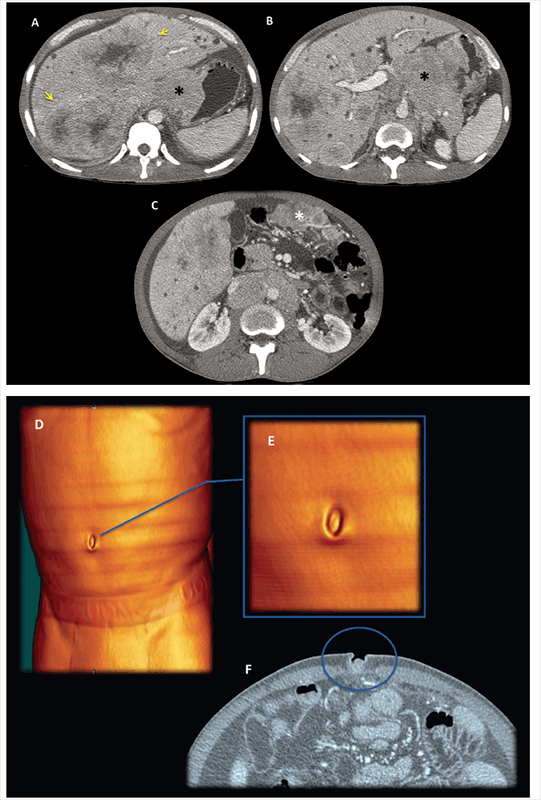 Man 50 years old, advanced gastric cancer in palliative care.