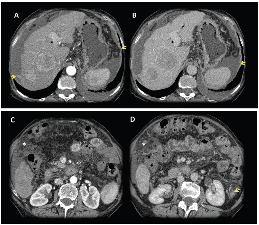 Female 81 years
old, advanced cirrhosis.
