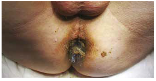 Migración de stent colónico.