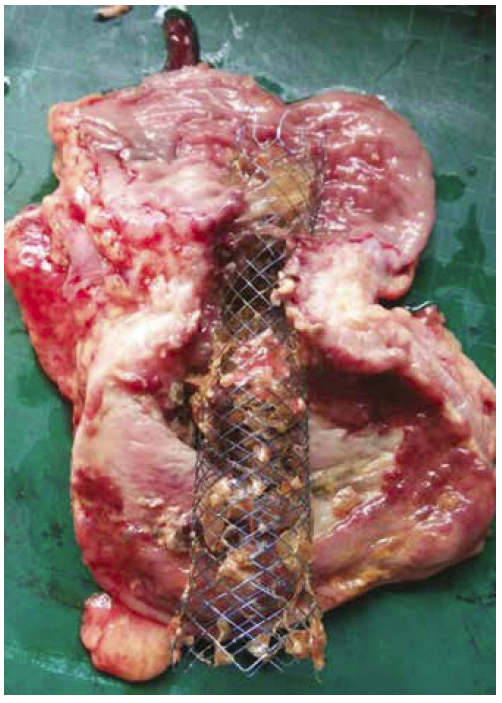 Pieza de colectomía con stent colocado
previamente.