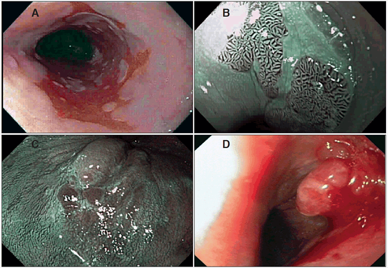 Evaluación
endoscópica durante la vigilancia de pacientes con EB. A. Esófago de
Barrett de segmento largo (mayor a 3 cm), cuya biopsia arrojó DBG. B. Lengüetas
de epitelio columnar evaluadas con NBI y asistencia con CAP. C. Área de
epitelio columnar con presencia de nódulos. D. Adenocarcinoma sobre epitelio
columnar de EB.