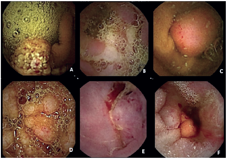 A) Formación tumoral maligna no neoplásica (hemangioma
cavernoso), B) linfoma T asociado a enteropatía, C) GIST
erosionado, D) linfoma folicular, E) y F) adenocarcinomas.