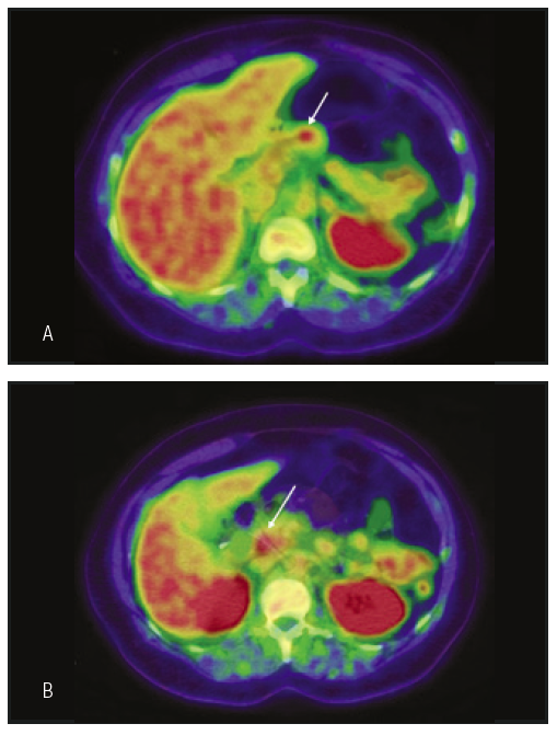 A) PET-TC
con 18F-DOPA plano axial, se observa captaciones focales del radiotrazador (flechas) en el lecho quirúrgico; y B) la cabeza pancreática con SUV MAX 5,3 y 5,1
respectivamente.