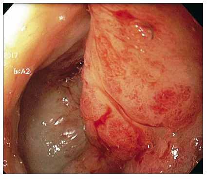Endoscopia inicial: se puede observar a nivel
del antro la lesión erosiva sangrante en napa, con edema de mucosa.