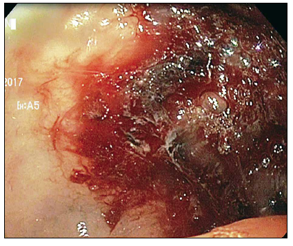 Imagen endoscópica post sesión de termocoagulación con argón plasma. Obsérvese la capa
cicatricial posterapia de coagulación.