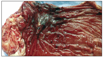Pieza operatoria de la gastrectomía subtotal.
Se observa en la imagen la región antral con edema de
la mucosa, la lesión erosiva sangrante y el tejido retráctil posterapia de coagulación con argón plasma.