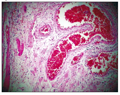 Imagen de anatomía patológica. Obsérvese la
congestión de los vasos, el edema de submucosa y el infiltrado inflamatorio.
