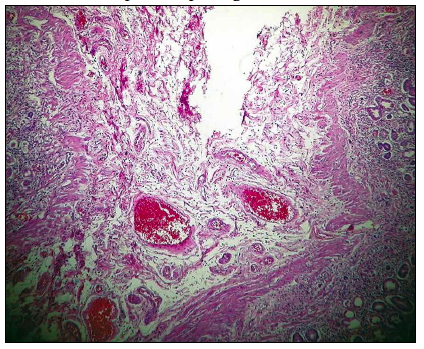 Imagen de anatomía patológica. Obsérvese
congestión de vasos, edema de submucosa e infiltrado inflamatorio en todas las
capas de la pared gástrica.