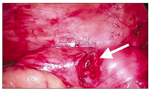 Laparoscopía
de la perforación en colon sigmoide.
