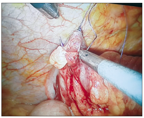 Rafia primaria completa de pared
colónica.