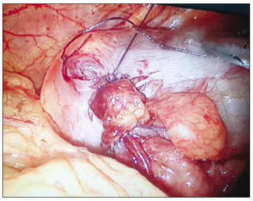 Rafia primaria
laparoscópica.