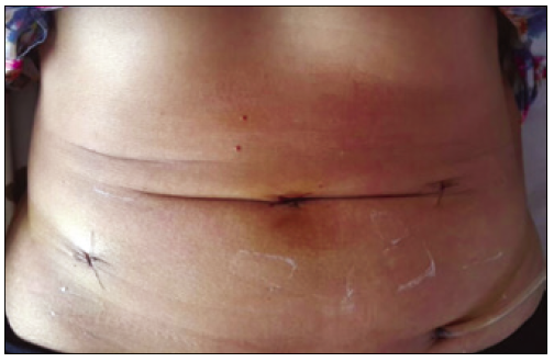 Cicatrices de la cirugía a
los 10 días de posoperatorio.