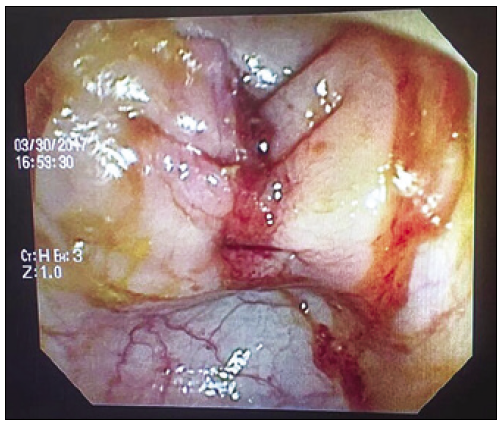 Visión
endoscópica de la rafia colónica.