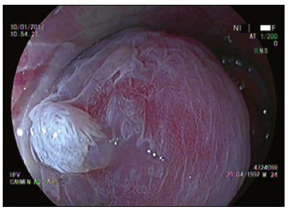 T&eacute;cnica de cromoendoscop&iacute;a y magnificaci&oacute;n,
tinci&oacute;n con &aacute;cido ac&eacute;tico al 4%. Lesi&oacute;n HPV acetoblanca.