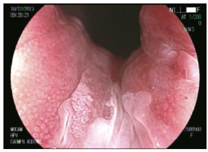 Patr&oacute;n en mosaico. Neoplasia intraepitelial de alto
grado.