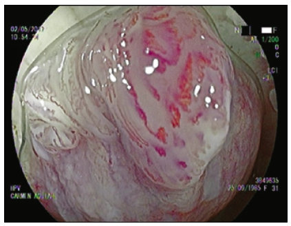 T&eacute;cnica de cromoendoscop&iacute;a l&aacute;ser, LCI. Destaque del
patr&oacute;n vascular.