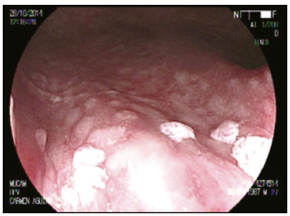 Lesiones HPV en recto.
