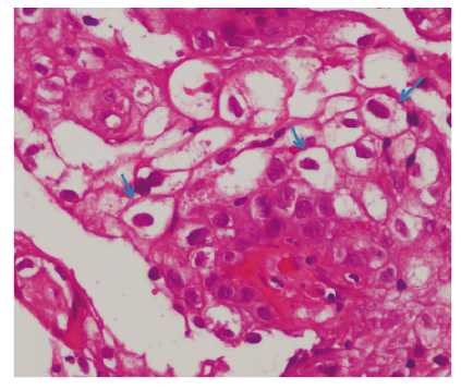 Con
hematoxilina-eosina, se muestran los coilocitos
(flechas) que son t&iacute;picos de la infecci&oacute;n viral por HPV. Constituyen c&eacute;lulas
escamosas grandes, redondeadas (&ldquo;c&eacute;lula en bal&oacute;n&rdquo;), con n&uacute;cleos aumentados de
tama&ntilde;o, desplazados hacia la periferia, que poseen una halo paranuclear.