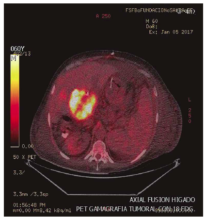 Tomografa con emisin de positrones con evidencia de lesin focal en el hilio heptico con SUV de 10.