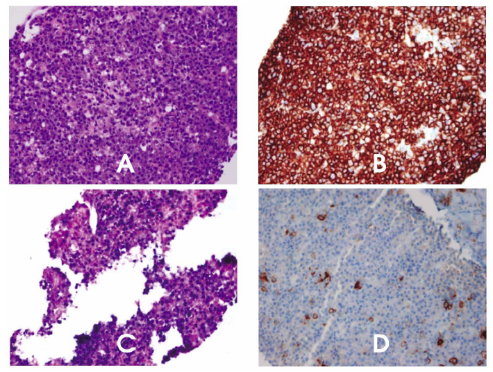 Biopsia de la masa del hilio heptico. A. HE 40x infiltrado tumoral constituido por abundantes plasmocitos. B. 40x CD138 positivo C. Epstein Barr Positivo D. 40x CD20 negativo.