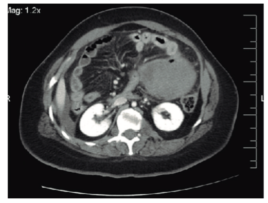 TC abdominal. Se observa la presencia de una masa que parece depender del intestino delgado y líquido libre en relación con una probable perforación tumoral.