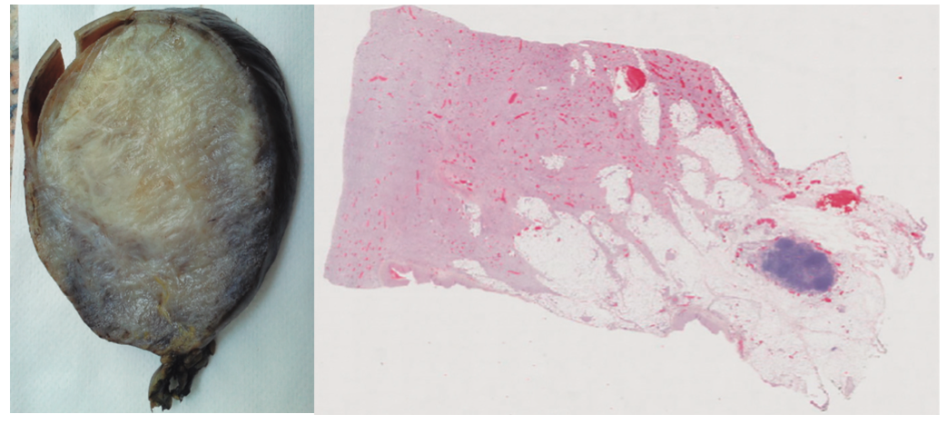 Aspecto macro y microscópico de la tumoración. Suele presentar un patrón mal circunscrito que se compone de la proliferación de células fusiformes estrelladas que forman fascículos largos sin mostrar generalmente atipía nuclear o hipercromasia, que son fuertemente positivas con vimentina. La inmunorreactividad nuclear a betacatenina se expresa frecuentemente, en el 67-80% de los casos.