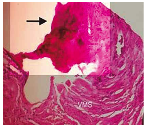 Microscopy image in which, the wall of the superior mesenteric vein is observed, its infiltration by ductal adenocarcinoma (100X). VMS: superior mesenteric vein. Black arrow: venous infiltration due to ductal adenocarcinoma.