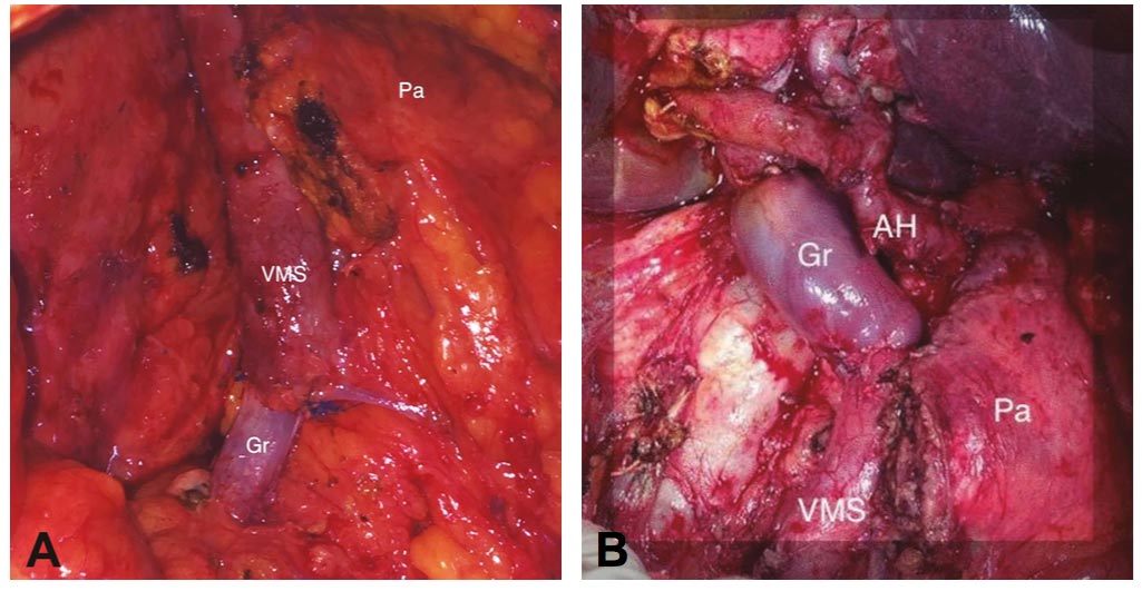 A) Intraoperative image after resection, where portal vein replacement is observed. Gr: venous graft. Pa: body and tail of pancreas. VMS: superior mesenteric vein. AH: Hepatic Artery. B) Ductal adenocarcinoma. Resection and replacement of superior mesenteric vein. Gr: venous graft. Pa: body and tail of pancreas. VMS: superior mesenteric vein.