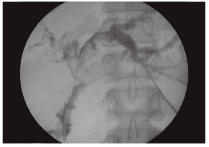 Colangiografía por el acceso percutáneo y pasaje de guía hacia el asa intestinal. Se observan múltiples defectos de relleno en ambos hepáticos y una estenosis a nivel de la anastomosis.