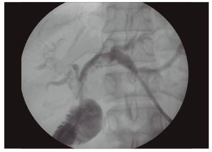 Colocación de drenaje interno-externo en forma percutánea. Se observan múltiples defectos de relleno en ambos hepáticos.