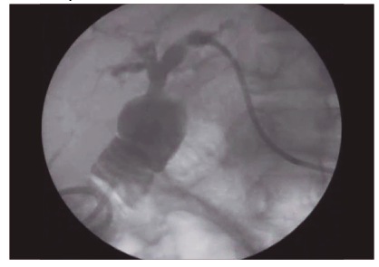 Colangiografía final luego de realizado el procedimiento combinado y previo al retiro del drenaje percutáneo en forma definitiva. No se observan defectos de relleno en la vía biliar y la anastomosis no se encuentra estenosada.