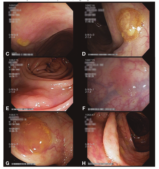 Aspectos endoscópicos de los adenomas/pólipos serrados sésiles. C) Bordes imperceptibles D) Capa de moco E) Forma de nube F) Interrupción de vasos G) Moco y detritus H) Pliegue engrosado