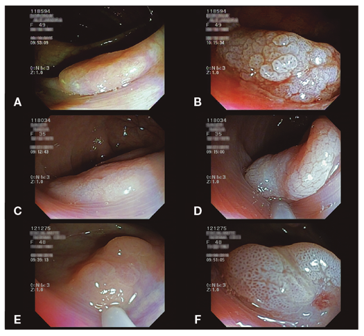 Efectos del ácido acético sobre los ASS/P: A, C, E) ASS/P del colon proximal (Olympus CF 150 - luz blanca estándar); B, D, F) las mismas lesiones luego de la aplicación de ácido acético 5%. Nótese en B) acetoblanqueamiento, incremento del volumen y realzamiento del patrón de superficie; D) incremento del volumen debido al efecto mecánico; F) característico patrón de superficie luego de la mucólisis: orificios de las criptas dilatados con tejido blanco interpuesto.